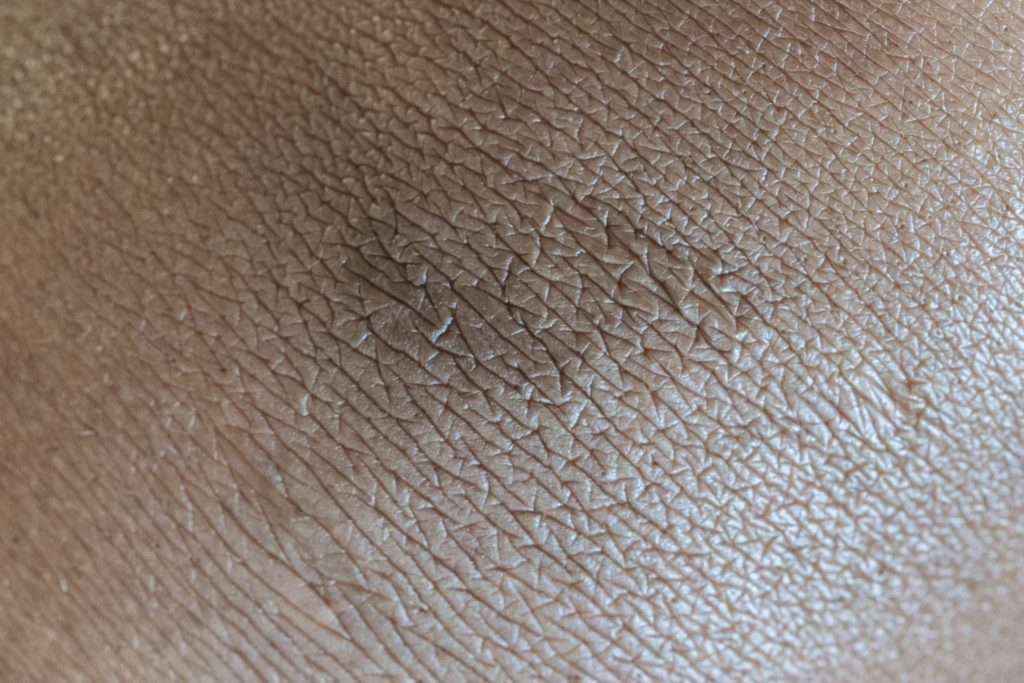 Skin surface with pigmentation spot in center